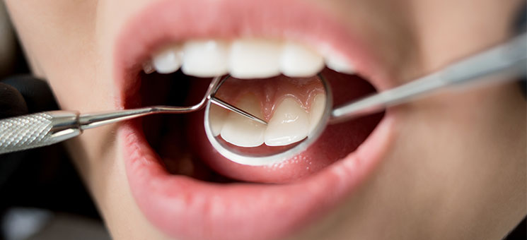 Zahnzusatz-Tarife: Mehr als zwei Drittel schneiden mindestens gut ab
