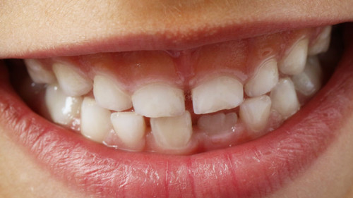 Laecheln-1743981-FO-woodypino