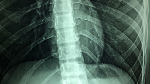 Roentgenaufnahme-1715903-PB-Taokinesis