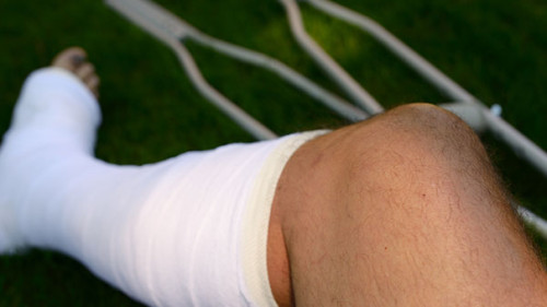 Bein-Gips-Kruecken-308085929-AS-Reimar