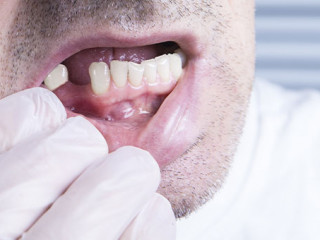 Zahnluecke-177381678-AS-Otto