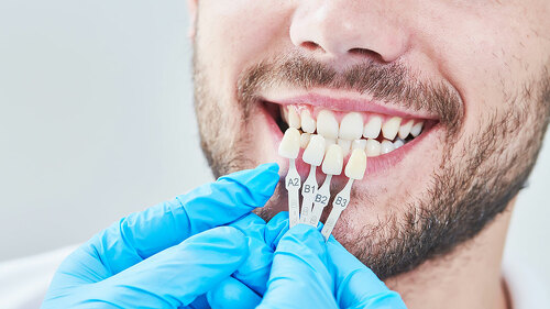 dentistry. matching colour of the tooth enamel with whitening chart