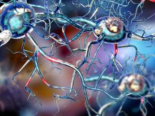 Damaged nerve cells, concept for neurodegenerative and neurologi