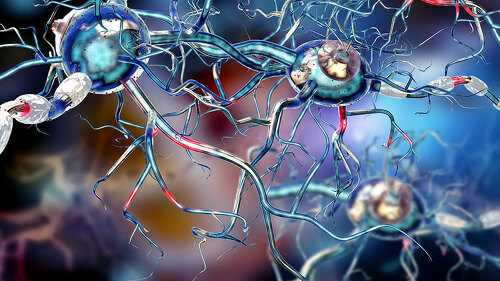 Damaged nerve cells, concept for neurodegenerative and neurologi