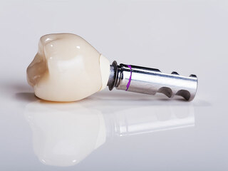 Zahnimplantat-94604519-FO-Nick-Freund