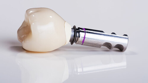 Zahnimplantat-94604519-FO-Nick-Freund