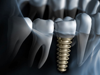 Implantat als Spätfolge? Prävention zielt darauf, solche Eingriffe möglichst zu vermeiden – besonders bei vulnerablen Gruppen.