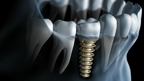 Implantat als Spätfolge? Prävention zielt darauf, solche Eingriffe möglichst zu vermeiden – besonders bei vulnerablen Gruppen.